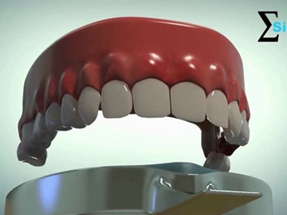 Bridge on dental implants