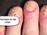 remedios caseros psoriasis  - tratamiento para psoriasis