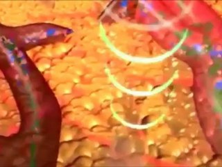 how ultrasound works for fat disruption