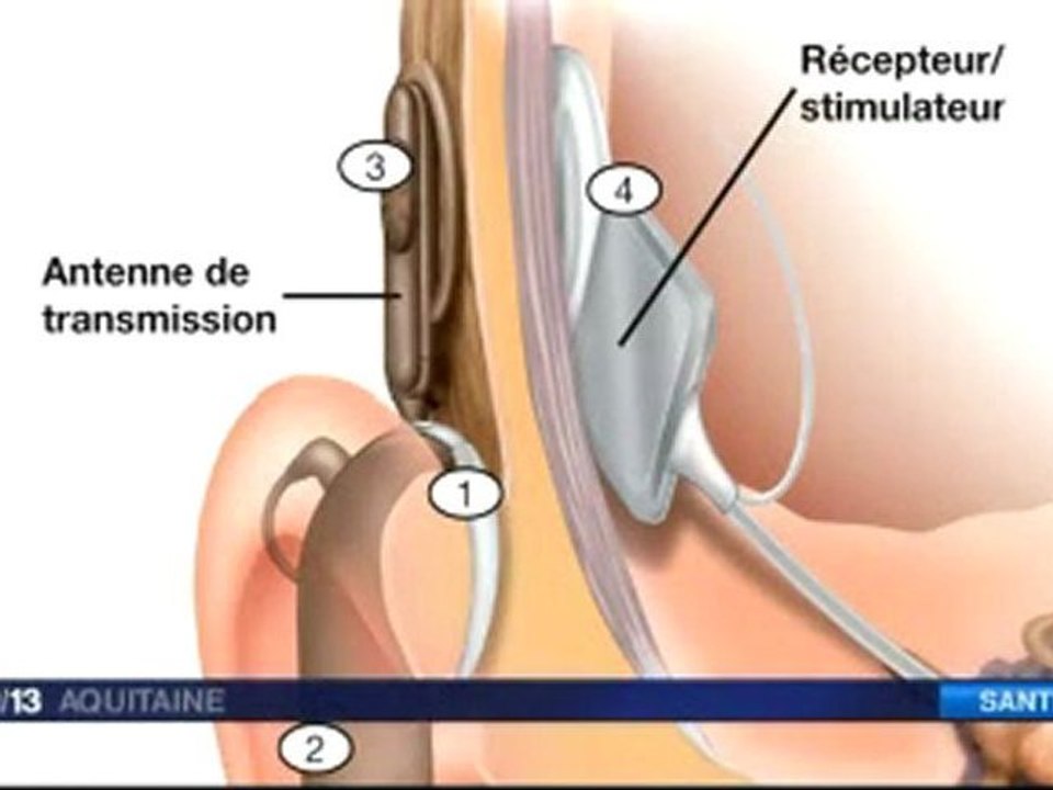 Les implants cochléaires