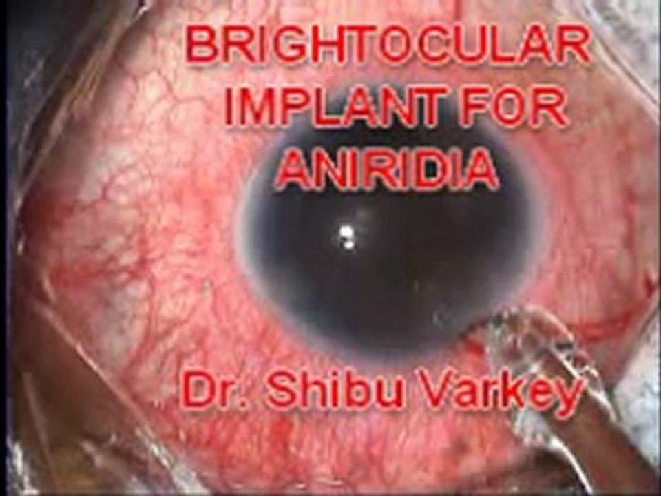 Eye color change surgery in Asia