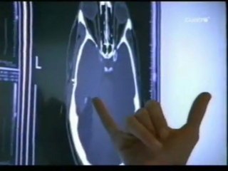 Amnesia global transitoria (AGT)