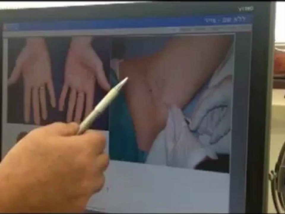 הזרקת בוטוקס היא אחת הדרכים לטיפול בהזעת יתר