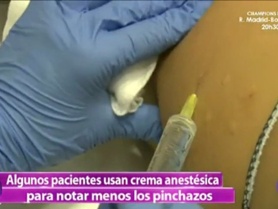 Mesoterapia con agujas en Madrid