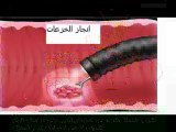 Lésions précancéreuses-Version en arabe-Dr AMINE A-Casablanca