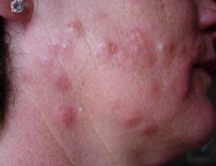 Get Rid of Bed Bugs Permantly - Bed Bugs Treatment Secrets