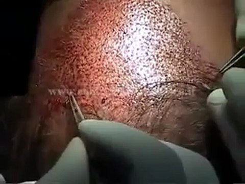 Saç Ektirme Merkezleri İstanbul