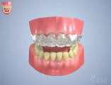 Chirurgie ethetique tunisie - Blanchiment des dents (Gouttière)