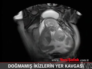 Doğmamış ikizlerin yer kavgası