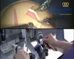Robotik cerrahi (da vinci robotik cerrahi) - Koru Hastanesi www.koruhastanesi.com