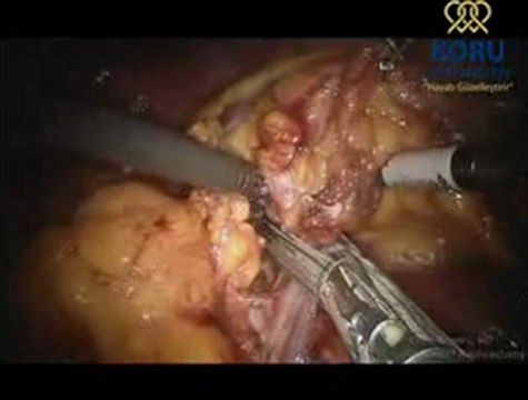 Radikal nefrektomi - da Vinci Robotik Cerrahi Sistemi - Koru Hastanesi +90-312-287-9797