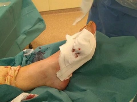 Hallux Valgus, traitement par la chirurgie mini-invasive percutanée