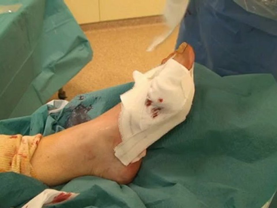 Hallux Valgus, traitement par la chirurgie mini-invasive percutanée