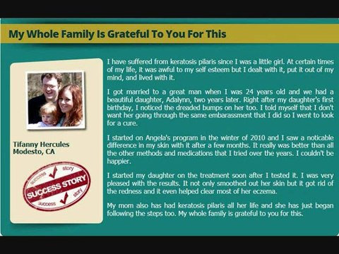 Keratosis Pilaris Natural Treatment, Cure KP In 5 Days Easily And Permanently,