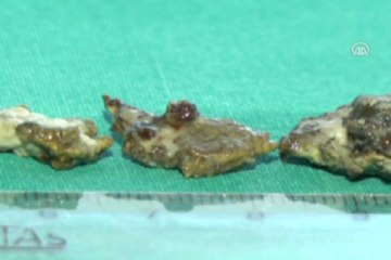 Baş ağrısıyla gitti burnundan taş çıktı