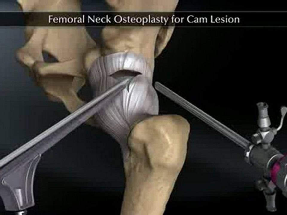 Femoral Neck Osteoplasty for Cam Lesion