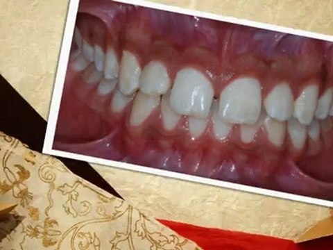 Colorado Springs Braces Nov2012