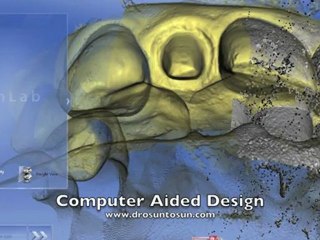 Klinik CAD CAM kuronlar