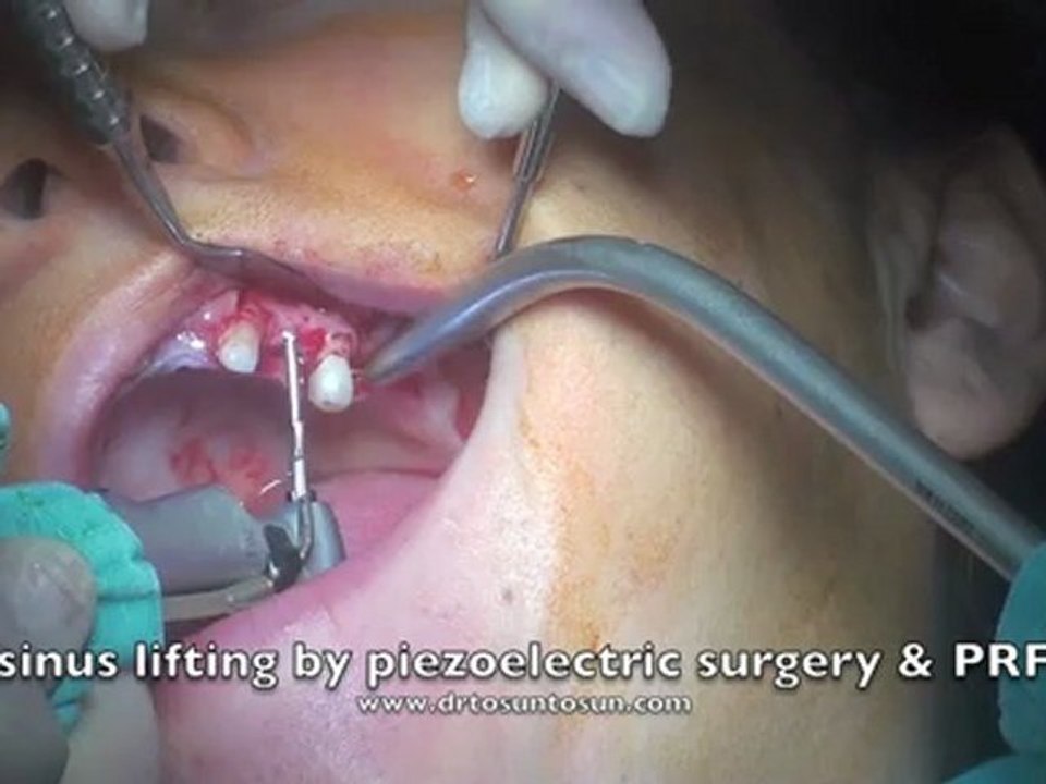 Periodontal tedavi ve sinus lift ile implant uygulaması