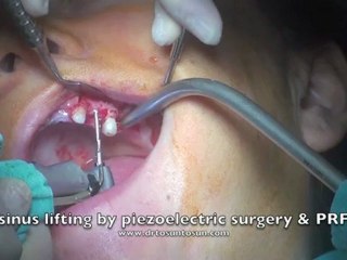 Periodontal tedavi ve sinus lift ile implant uygulaması