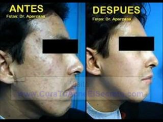 Cura Para El Acne 2012 *SOLUCION*