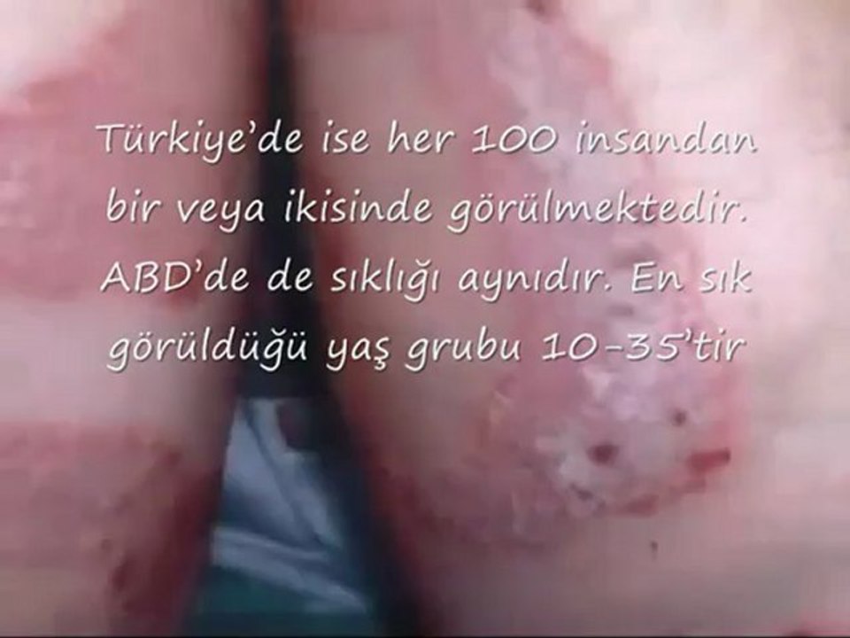SEDEF HASTALIĞİ  Tamer Karahan Mediser Medikal Şikayet