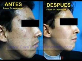 Cura Para El Acne AQUI DESCUBRIMIENTO