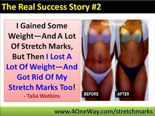 How To Get Rid Of Stretch Marks Naturally