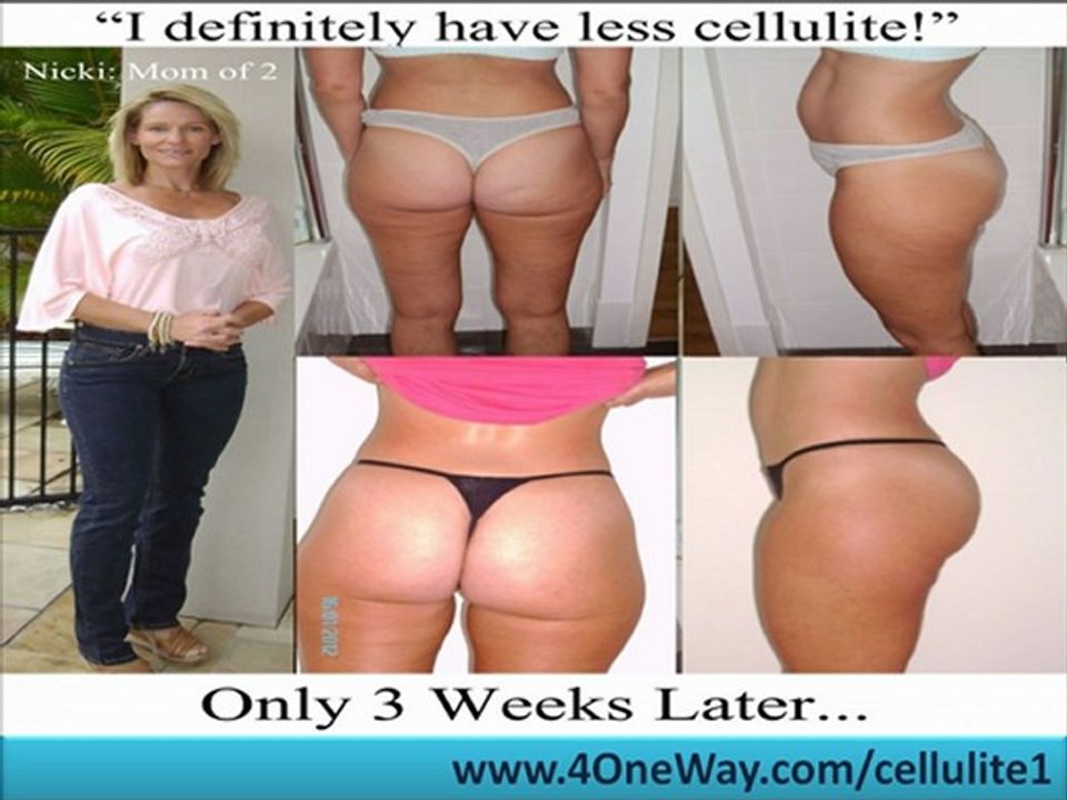 Reduce Cellulite - Cellulite Removal