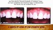 Dentists Implants Costa Mesa Veneers Dentures Cosmetic Dentistry Invisalign Dental Services