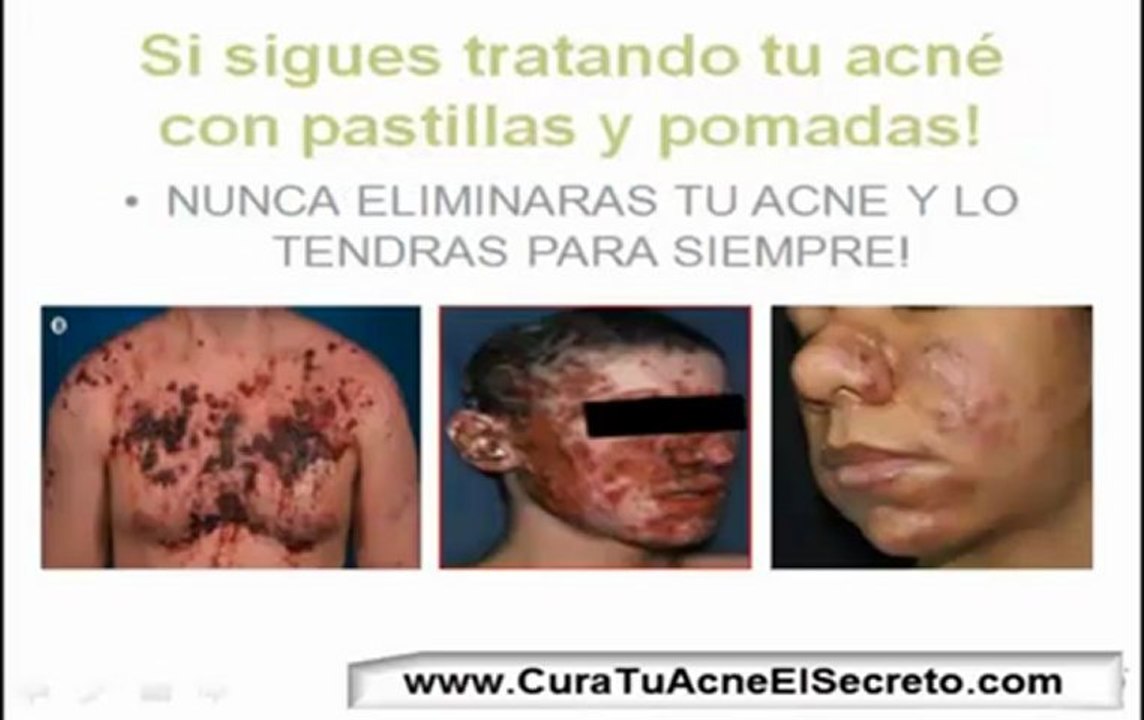 Como Eliminar El Acne Rapido *SECRETO*