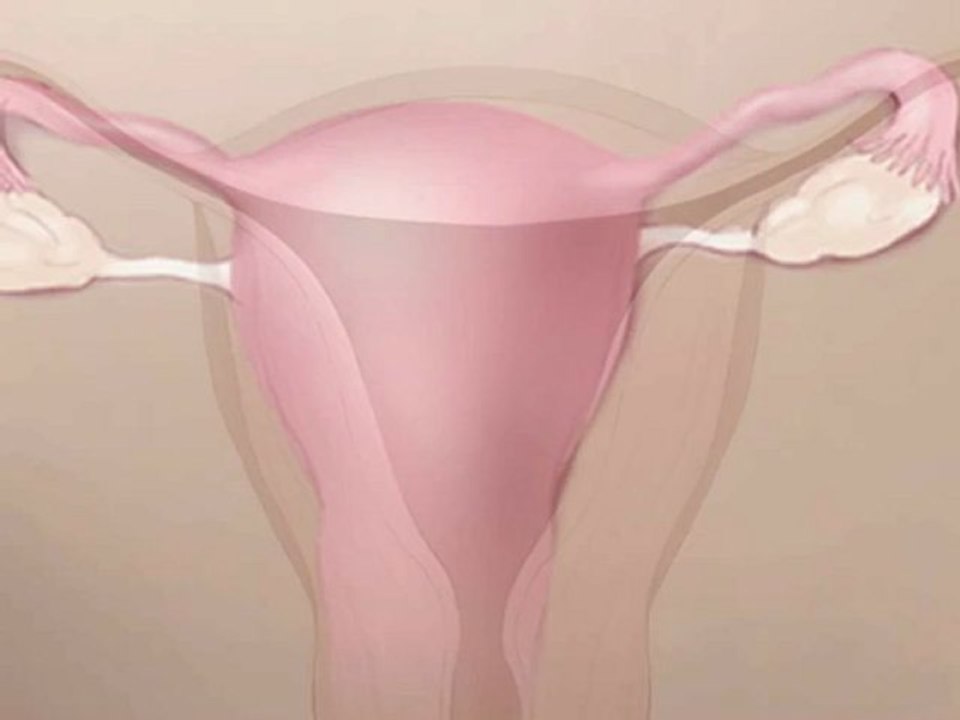 ד"ר אילון לחמן - כל מה שצריך לדעת על אמצעי מניעת הריון קבוע