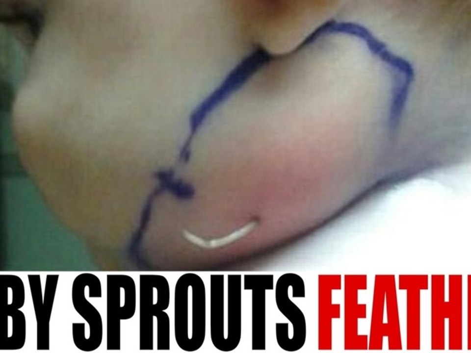 Doctors Find Feather Lodged in Baby's Face