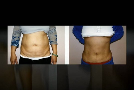 Liposuction in NYC | Manhattan Plastic Surgeon