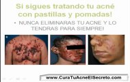 Eliminar Cicatrices De Acne *AQUI LA CURA*