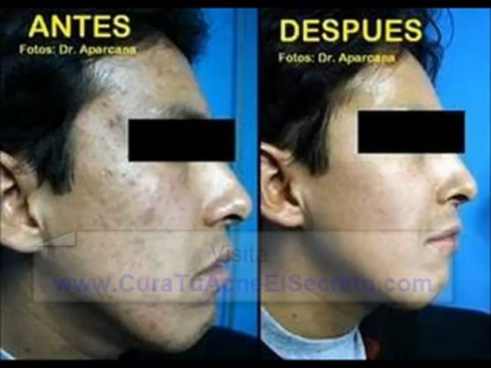 Como Eliminar El Acne Rapidamente