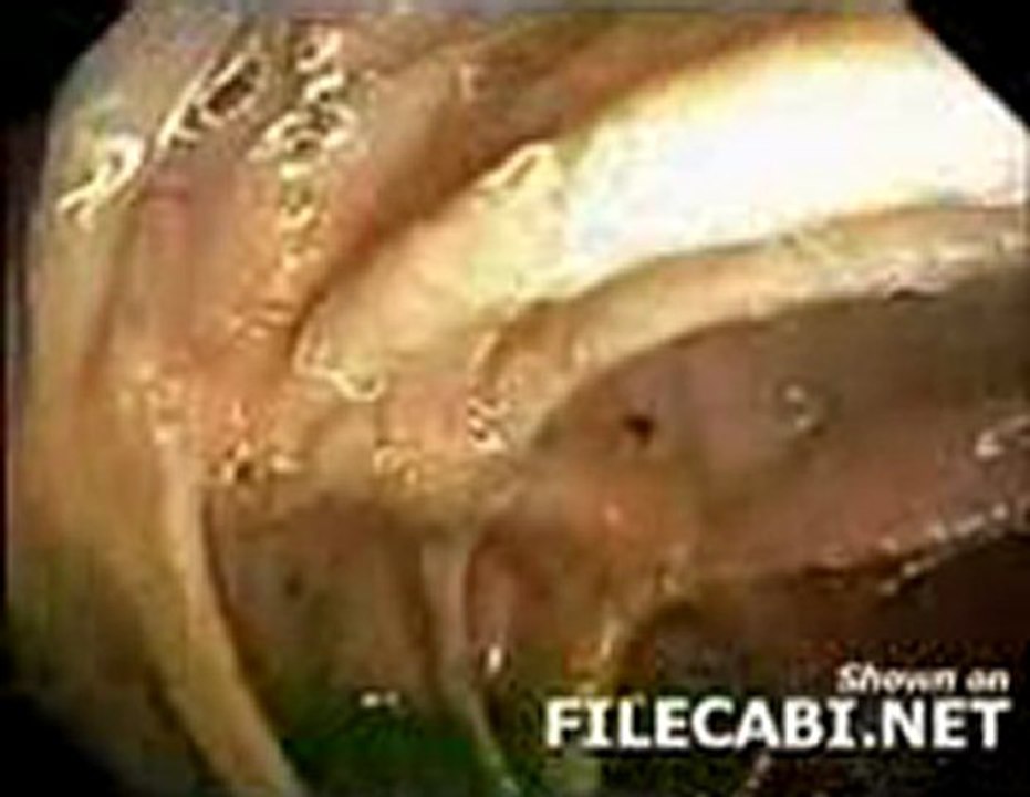 kilkurdu bagirsak paraziti Mediser Medikal