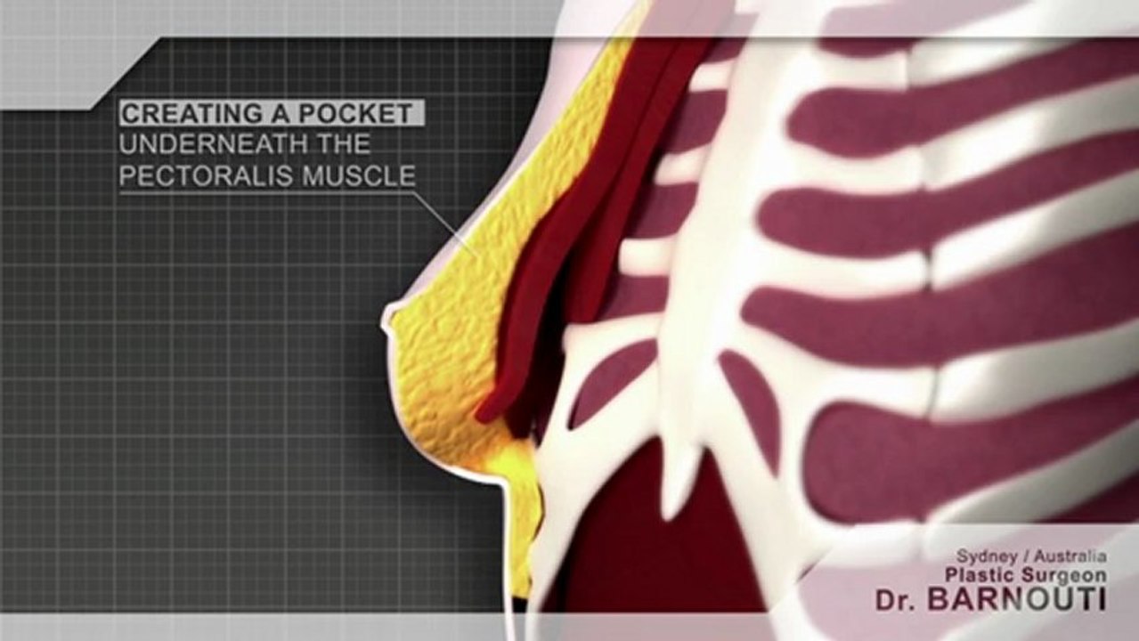 Breast Implants Surgeon Breast Augmentation, Breast Reduction, Breast Specialist