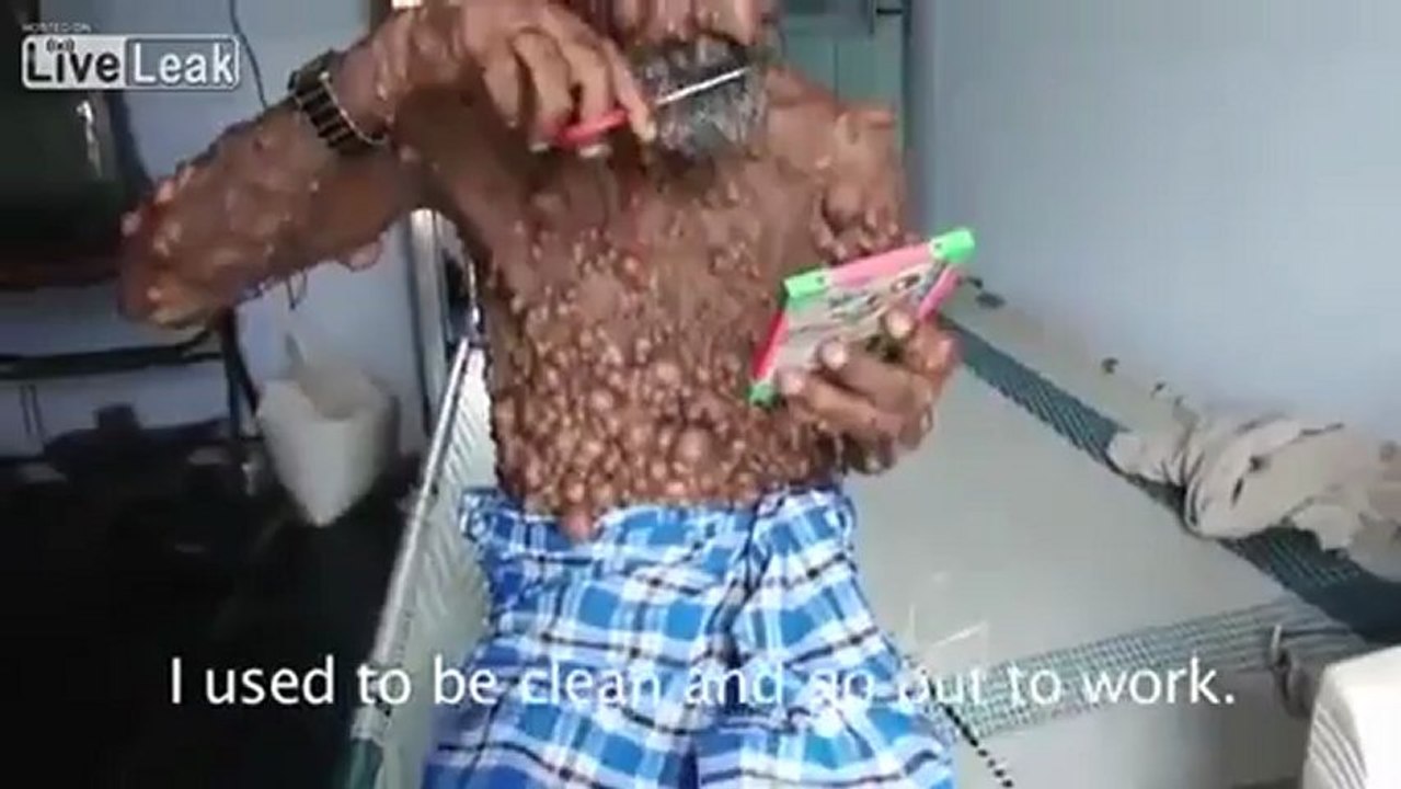 Man With Major Zits Spots