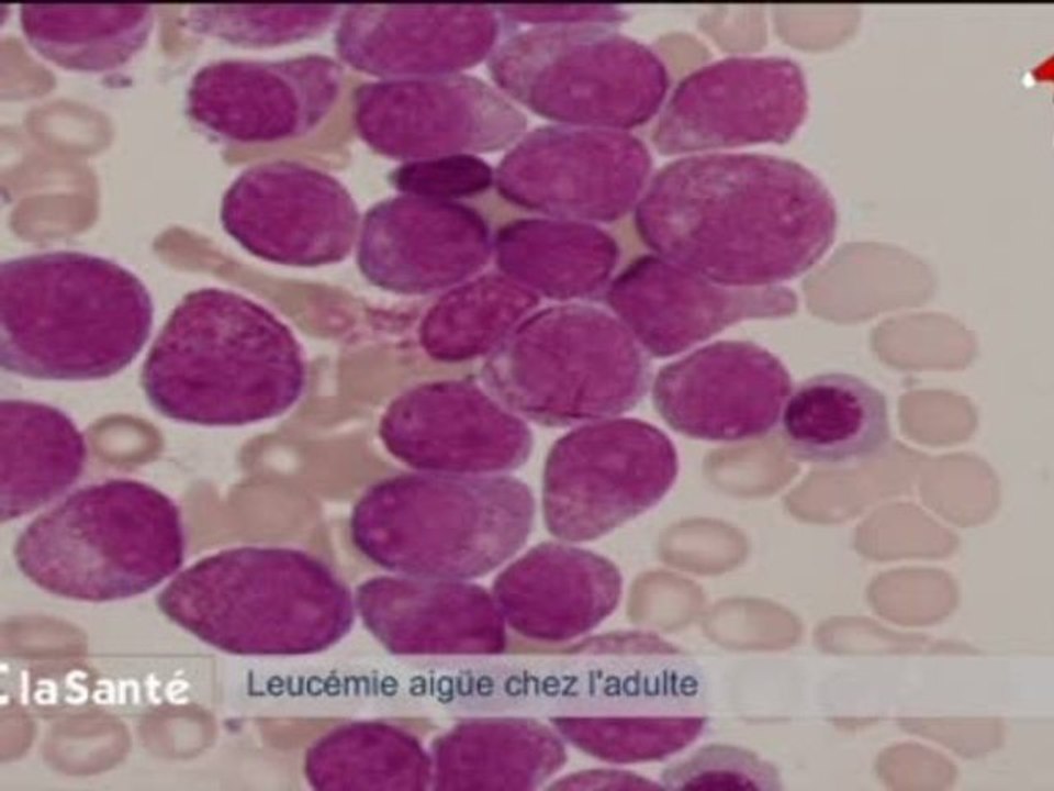C La Santé : Leucémie et cancer de la moelle osseuse