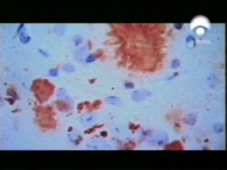 Alzheimer: Hipotesis de las placas seniles