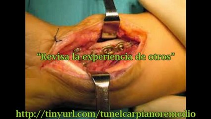 Como se cura el tunel carpiano