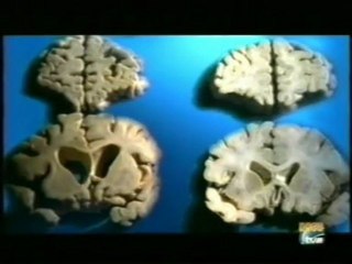 Enfermedad de Alzheimer: Neuropatologia