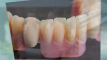 Dental Implants San Antonio Clinics Offer