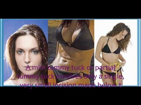 A tummy tuck isn’t meant to be a weight-loss measure