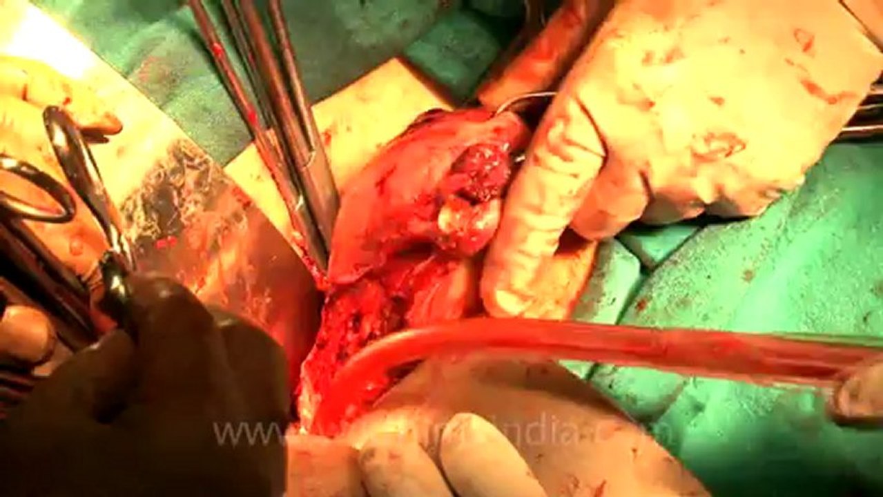 Max hospital-removal of uterus.mov