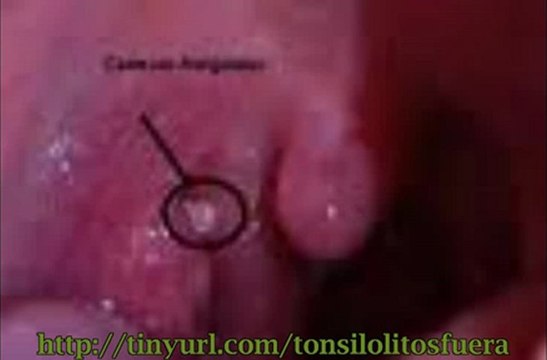 Remedios caseros para calculos amigdalinos