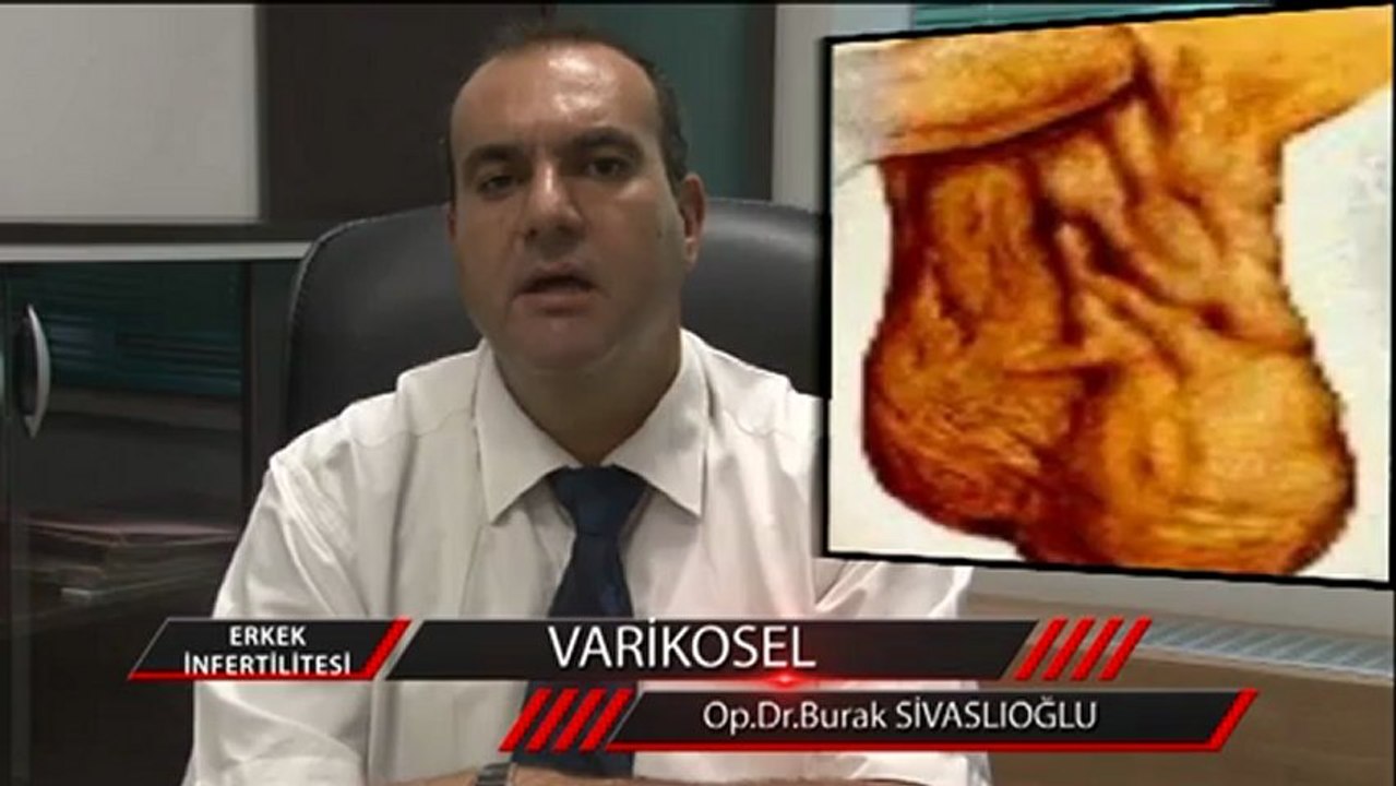 (varikosel)