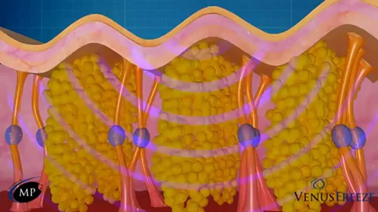 Venus Swan™ Non-Surgical Body Contouring and Skin Tightening