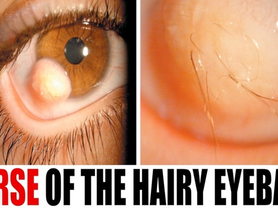 Man Sprouts Hair from Eyeball video Dailymotion